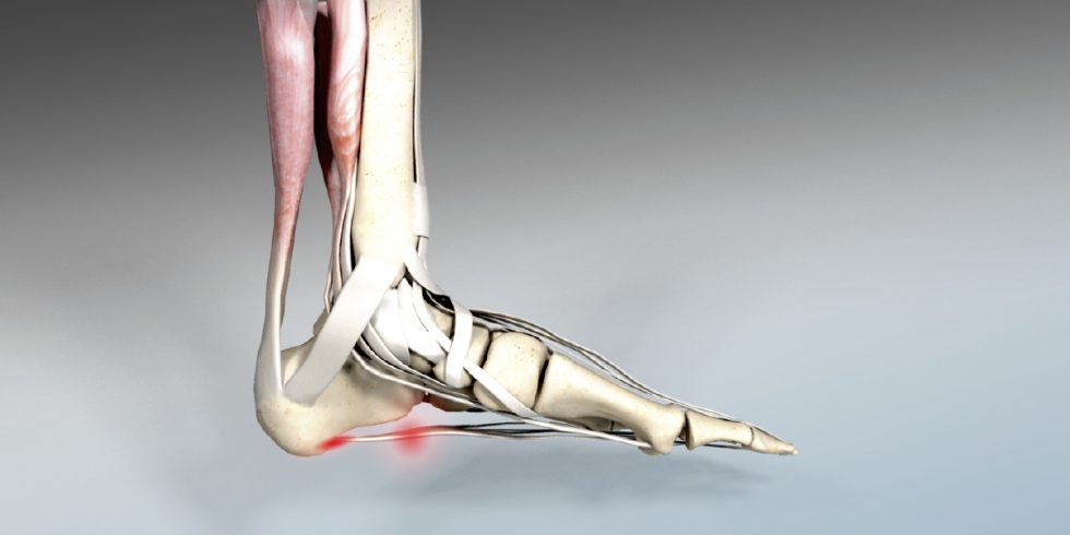 Fersensporn – Achillodynie / Plantar Fasciitis | gutgehen Dr. med ...