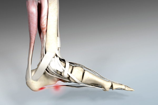 Fersensporn – Achillodynie / Plantar Fasciitis